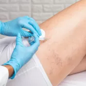 Ameliyatsiz Varis Tedavisi 2