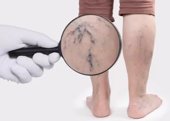 Tıkalı Damarlara Girişimsel Tedaviler