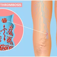 Derin Ven Trombozu Tedavisi