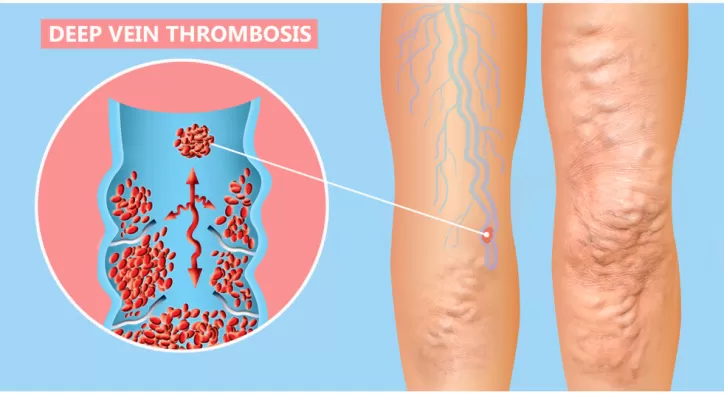 Derin Ven Trombozu Tedavisi