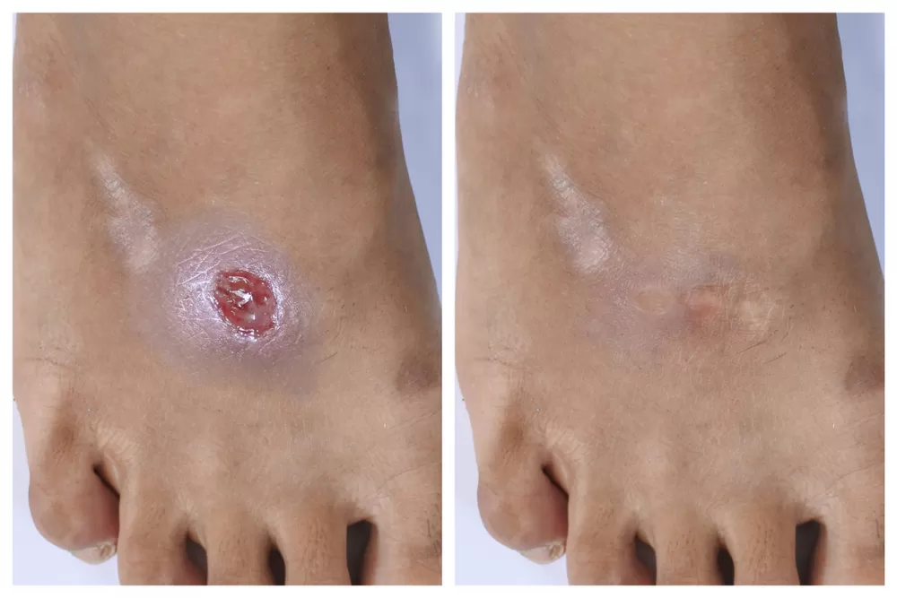 diyabetik ayak öncesi sonrası