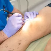 Kilcal Damar Tedavi Yontemleri 1