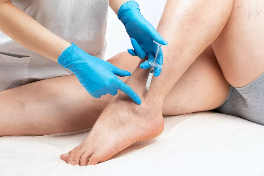 köpüklü varis tedavisi