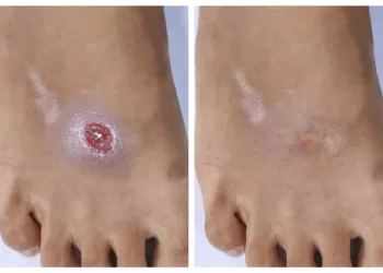 Kronik Yaralar Nasıl Tedavi Edilir?