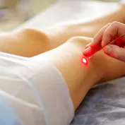 Lazerle Kilcal Damar Tedavisi 3