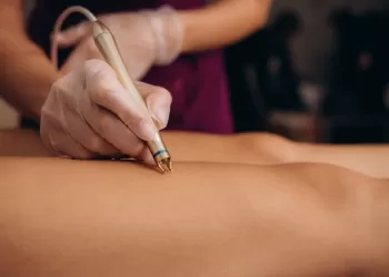 Lazerle Varis Tedavisi Nasıl Yapılır?