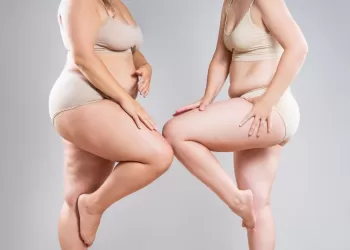 Lipödem Nedir? Lipödem Tehlikeli midir?