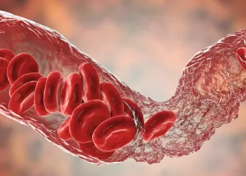 Pulmoner Emboli Tedavisi