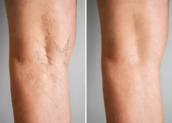 Radyofrekans Varis Tedavisi