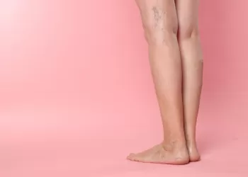 Bacaklardaki Varis Nasıl Geçer? - Bacaklardaki Varis İzleri Geçer mi?