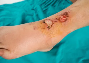 Ayak Bileği Yaraları Amniyotik Membran ile Nasıl Tedavi Edilir?