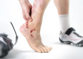 Ayak Bileği Yaraları Eksozom Tedavisi ile Çözüme Kavuşturabilir mi?