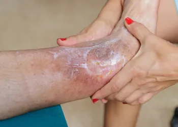 Ayak Bileği Yaralarında Kök Hücre Tedavisi