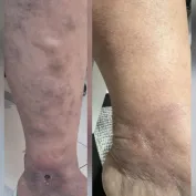 Ilerlemis Varis Tedavisi