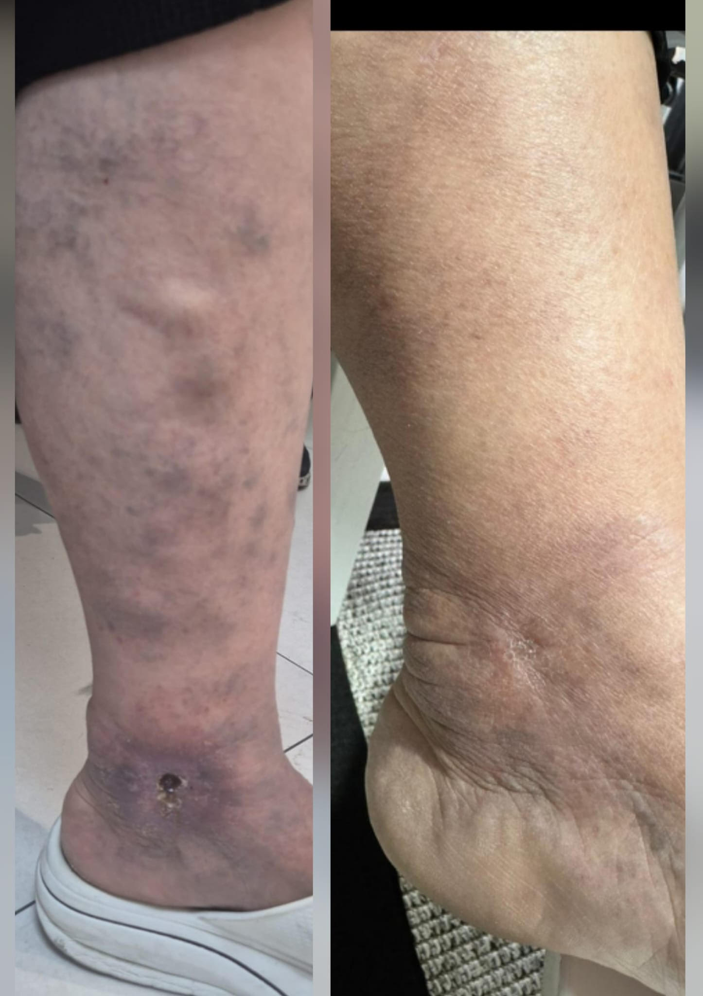 Ilerlemis Varis Tedavisi