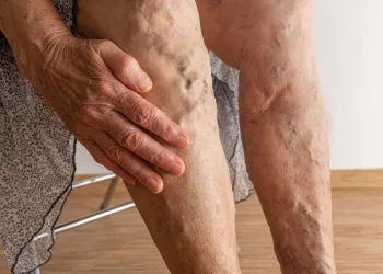 İlerlemiş Varis Tedavisi: İyileşmeyen Ayak Bileği Yaraları (Venöz Ülser) Kaderiniz Değil