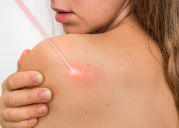 Vücudun Kırmızı Sinyalleri: Kırmızı Benler ve Yeni Nesil Silgi Lazer Çözümü