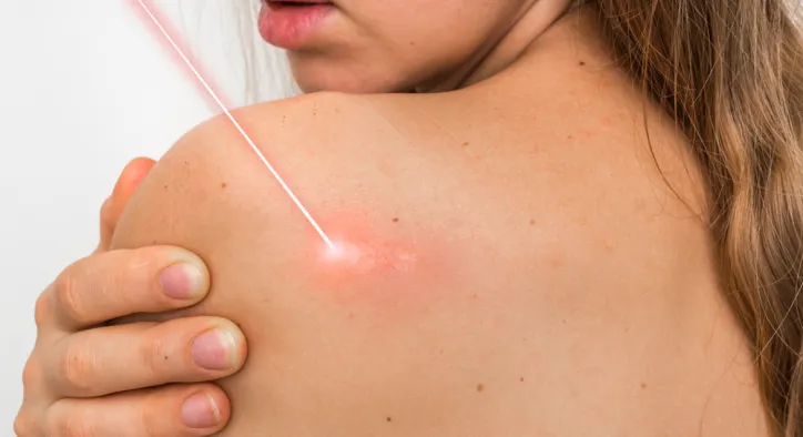 Vücudun Kırmızı Sinyalleri: Kırmızı Benler ve Yeni Nesil Silgi Lazer Çözümü