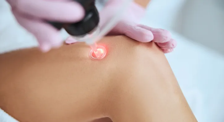 Lazerle Varis Tedavisi Kaç Seans? Tedavi Sürecini Belirleyen Faktörler