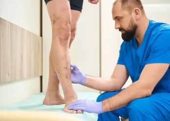 Varis Çok İlerlerse Ne Olur? İhmal Edilen Damar Sağlığının Riskleri