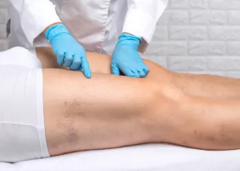 Varis Nedir? Neden Olur? Damar Sağlığınızın Sessiz Sinyalleri