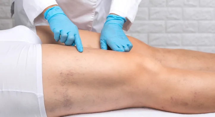 Varis Nedir? Neden Olur? Damar Sağlığınızın Sessiz Sinyalleri