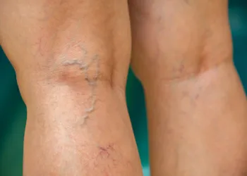 Varisin Çeşitleri Neler? Damar Sağlığınızın Renkli Haritası