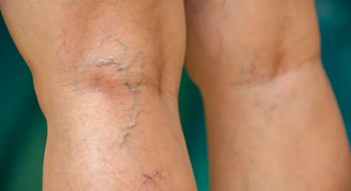 Varisin Çeşitleri Neler? Damar Sağlığınızın Renkli Haritası