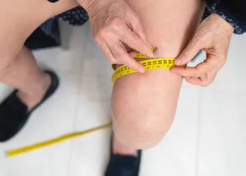 Bacakta Lenfödem Belirtileri Nelerdir?