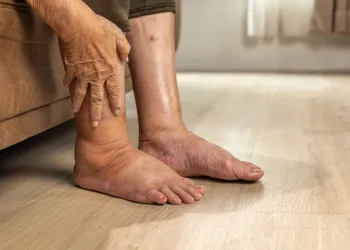 Lipödem Belirtileri - Lipödem Olduğumu Nasıl Anlarım?